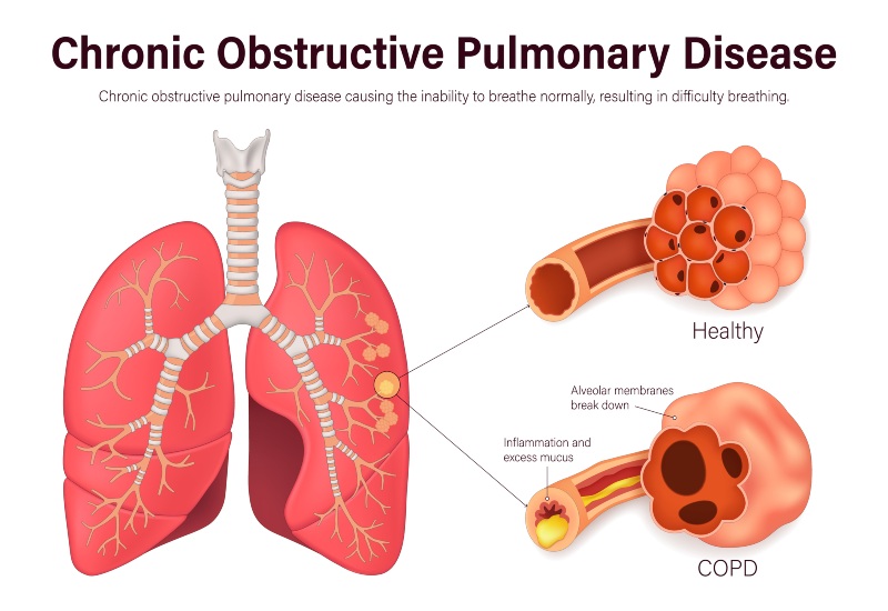 COPD lung diagram showing healthy vs damaged alveoli and airways in Glenview & Northbrook, IL